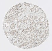 IHC of prostate cancer labeled with DSHB antibody CPTC-ADA-1 against Adenosine Deaminase Peptide 1. Image Credit: NCI-Clinical Proteomic Technologies for Cancer.